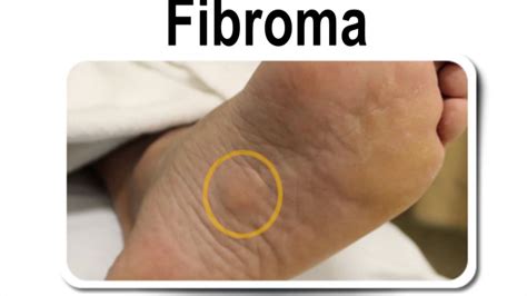 19+ Plantar Fibroma Picture - KaranYazmin