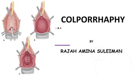 COLPORRHAPHY.pptx