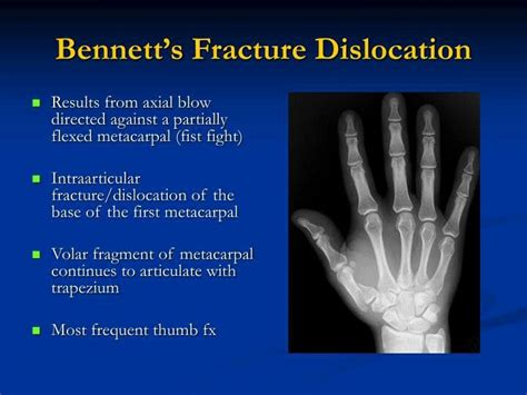 Bennett Fracture