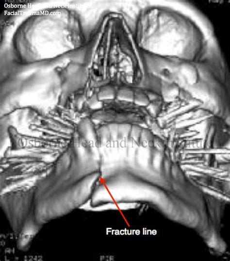 Jet’s Quarterback, Geno Smith, Suffers a Broken Jaw?