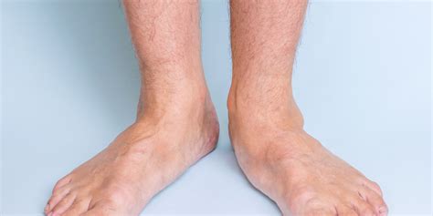 What is overpronation? Causes and treatments for your feet. – Bilt Labs