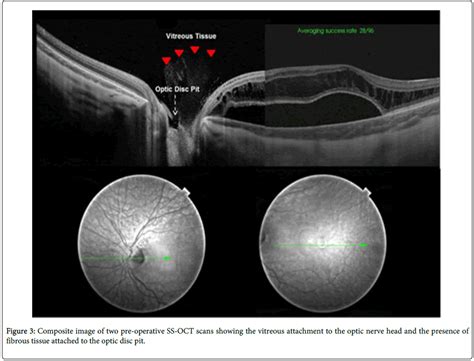 Pars Plana Vitrectomy with Air Tamponade for Optic Disc Pit Macul