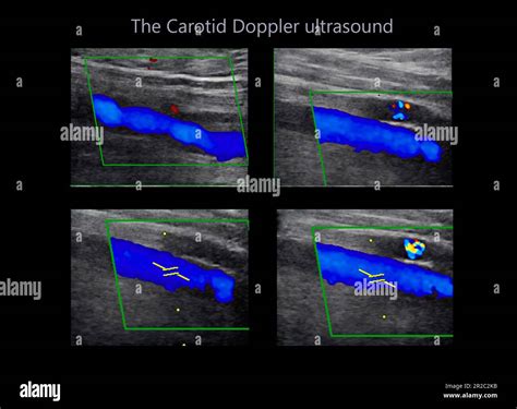 A Carotid Artery Doppler Ultrasound Is A Diagnostic Test, 47% OFF