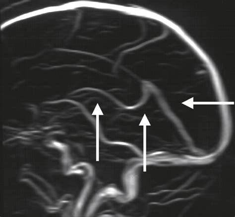 Acute Hebephrenia | Psychiatry | JAMA Neurology | The JAMA Network