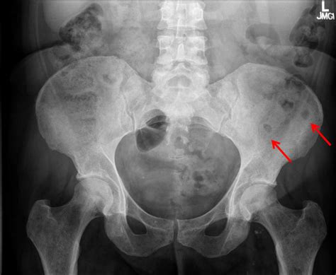 X‐ray of the pelvis demonstrating lytic lesions (arrows) of the left ...