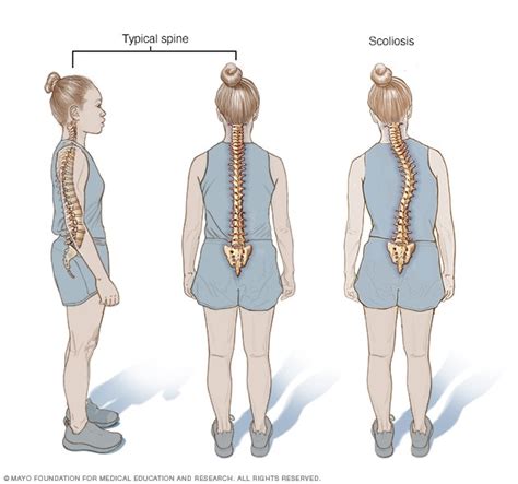 Scoliosis - Symptoms and causes - Mayo Clinic