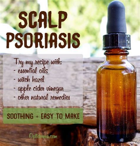 Psoriasis on Scalp: Try this Soothing & Moisturizing DIY Recipe (With ...