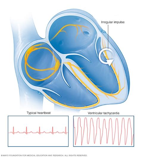 Sick sinus syndrome - Symptoms and causes - Mayo Clinic