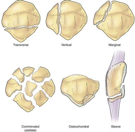 Stellate Fracture Recovery – FRACTURE