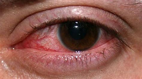 keratoconjunctivitis sicca | pathology | Britannica