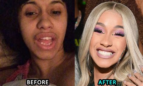 Cardi B Plastic Surgery, New Teeth, Boob Job, Butt Injections, Before After Pictures ...