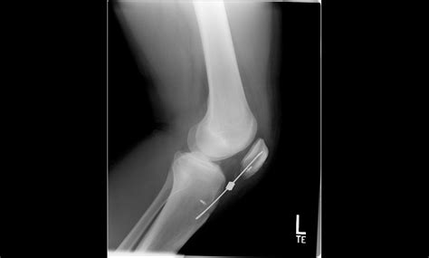 Better Outcomes for Patellar Tendon Ruptures | SHELBOURNE KNEE CENTER