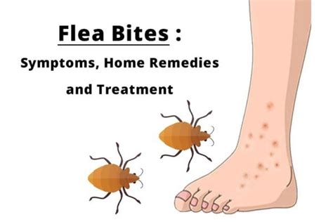 Flea Bites : Symptoms, Home remedies and Treatment