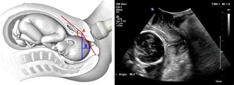 Figure 1 from Transperineal ultrasound technique for evaluating angle of progression and ...