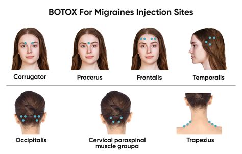 BOTOX For Migraines Bellevue & Kirkland | Best BOTOX Bellevue