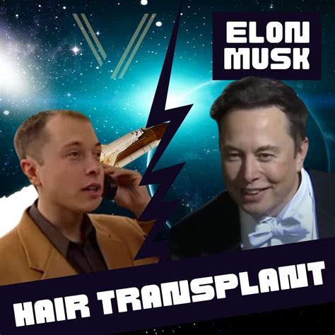 Elon Musk Hair Transplant: Before and After Transformation