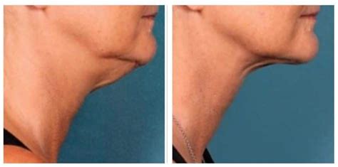 Ozempic® Face: Treating Loose Skin After Rapid Weight Loss - Rendon Center