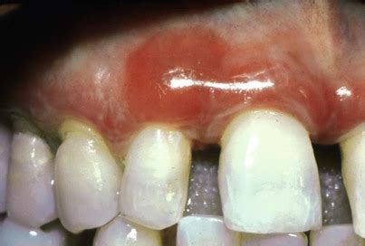 19: Desquamative Gingivitis | Pocket Dentistry