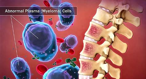 A Visual Guide to Multiple Myeloma | Myeloma, Multiple myeloma ...