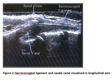 Caudal Anesthesia Technique