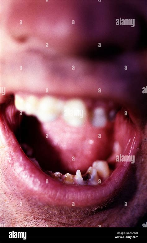 Man with decaying teeth Stock Photo - Alamy