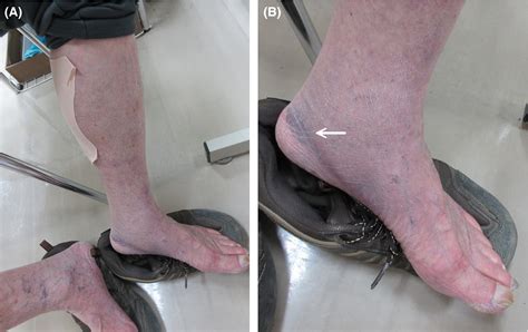 The crescent sign of ruptured baker's cyst - Mizumoto - 2019 - Journal of General and Family ...