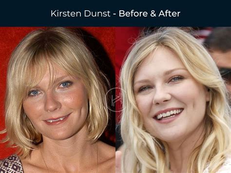 Kirsten Dunst Plastic Surgery Before After Breast Implants | The Best ...