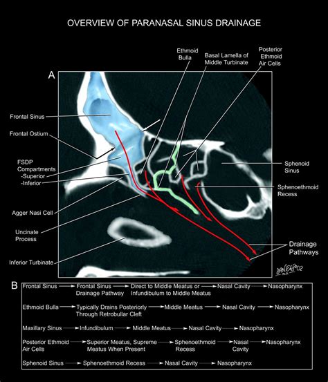 The Frontal Sinus Drainage Pathway and Related Structures | American ...