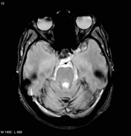 Superficial siderosis | Radiology Reference Article | Radiopaedia.org