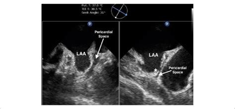 Transesophageal echocardiography (TEE) image of a left atrial appendage... | Download Scientific ...