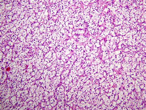 Renal Cell Carcinoma Histology