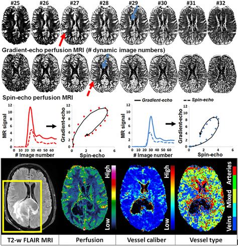 Perfusion MRI and vessel-architectural imaging (VAI). Merging two... | Download Scientific Diagram