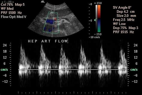 Image Result For Common Hepatic Artery Liver Anatomy Ultrasound | My XXX Hot Girl