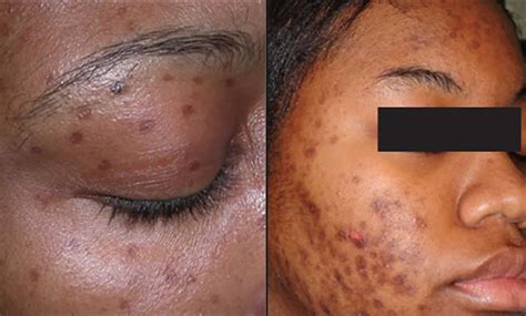 Skin discoloration causes and dark or white skin discoloration treatment