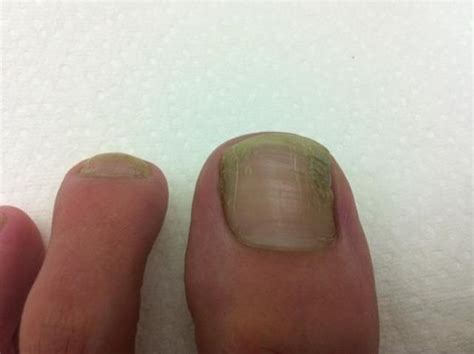 Toenail Fungus Pictures Before and After Treatment - Nails Journal