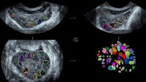 Ob/Gyn Updated : Photo of the day: Three-dimensional sonography-based automated follicle count ...