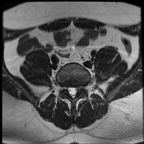 Ankylosing Spondylitis Mri Si Joints