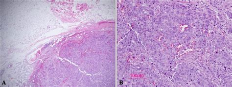 Microscopic findings of a large cell neuroendocrine carcinoma. (A ...