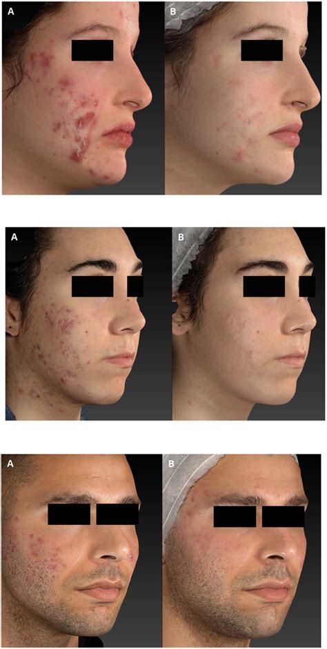 Nodulocystic acne before (A) and after (B) 4 sessions of IPL treatment... | Download Scientific ...