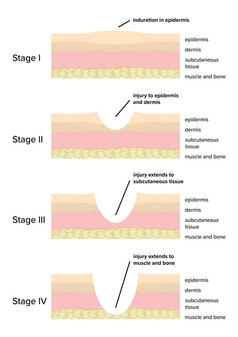 When faced with a complex instance of wound care, many first time or novice clinicians will ask ...