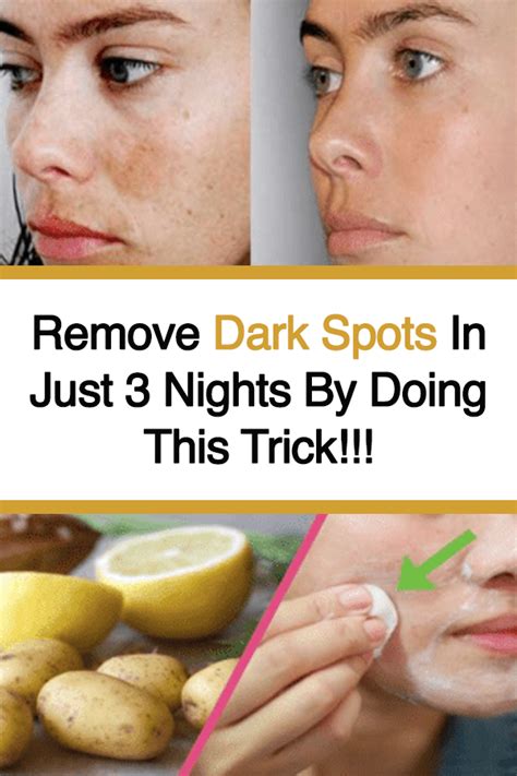 Remove Dark Spots In Just 3 Nights By Doing This Trick | Brown spots on face, Remove dark spots ...