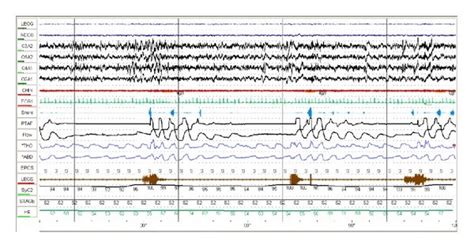 (a) Diagnostic polysomnogram showing obstructive events (arrows). Leads... | Download Scientific ...