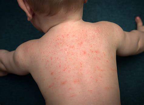 Baby Rashes: Types, Symptoms & More