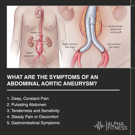 What are the symptoms of an abdominal aortic aneurysm? - AlphaFitness