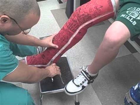 GIANT FULL LEG CAST REMOVAL (SCARY!) - YouTube