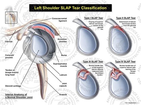 Shoulder Labral Tears – (SLAP Tears) - Enhance Physiotherapy