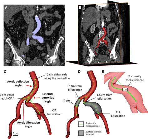 Morphology and Hemodynamics in Isolated Common Iliac Artery Aneurysms ...