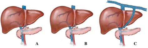 File:Dog liver portosystemic shunts.jpg - Embryology