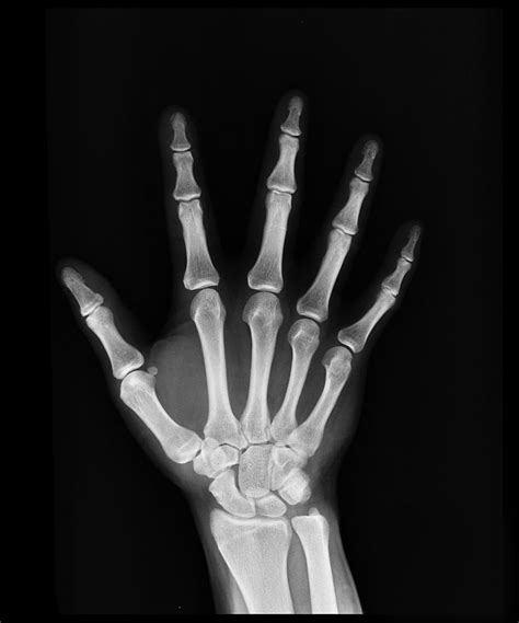 X Ray Hand Bones