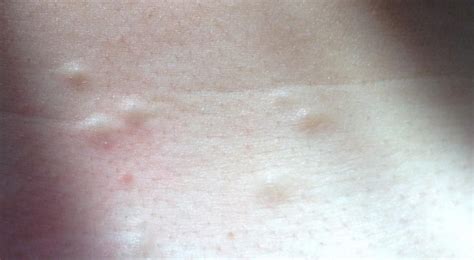 Small lumps under skin on chest – What are they? Can you please help? – Back/Body/Neck acne ...